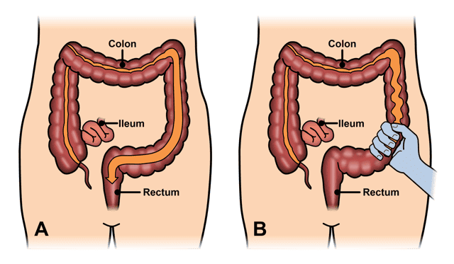 thuốc trị viêm loét dạ dày