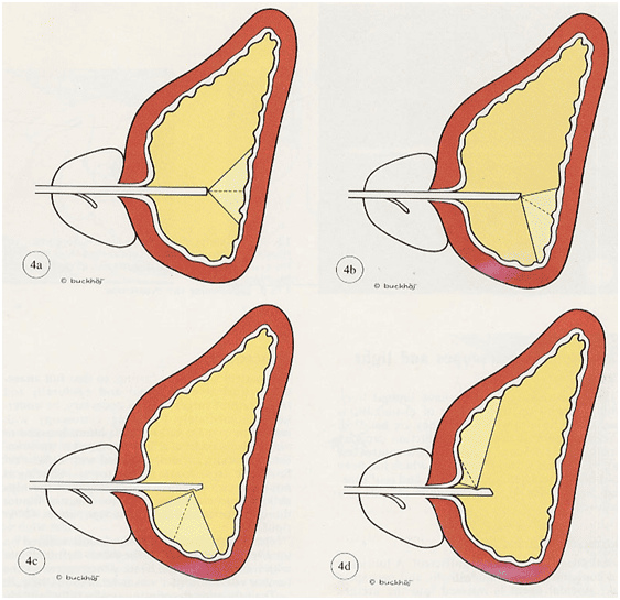 Nội soi bàng quang (Cystoscopy)