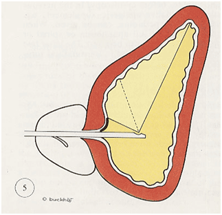 Nội soi bàng quang (Cystoscopy)