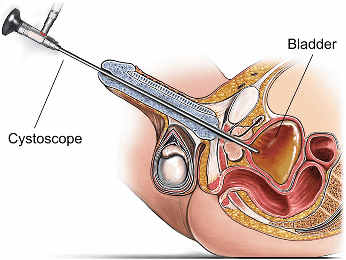 Nội soi bàng quang (Cystoscopy)