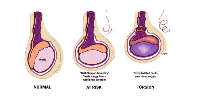 Neonatal and Pediatric Testicular Torsion