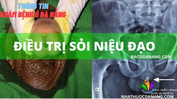 ĐIỀU TRỊ SỎI NIỆU ĐẠO