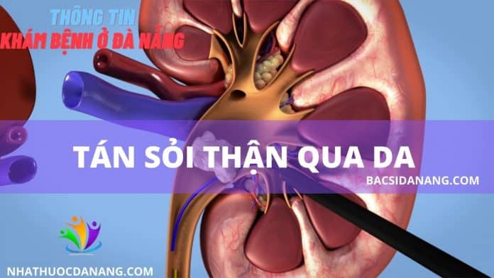 Tán sỏi thận qua da tại đà nẵng