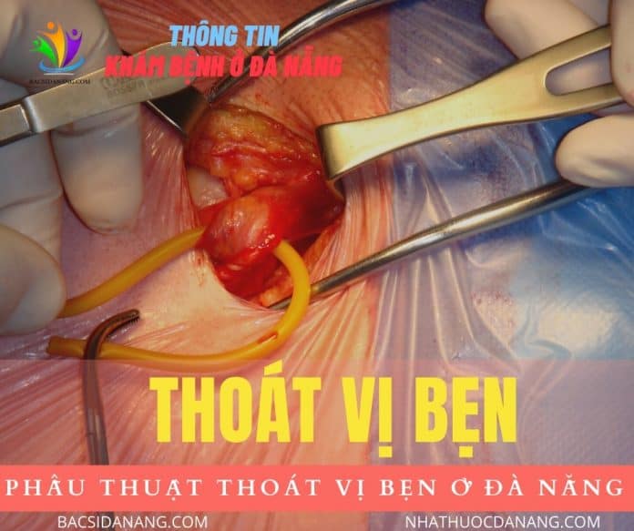 PHẪU THUẬT THOÁT VỊ BẸN Ở ĐÀ NẴNG