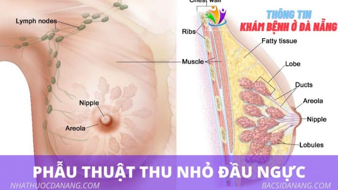 Những biến chứng phổ biến có liên quan đến thu gọn núm vú là gì?
