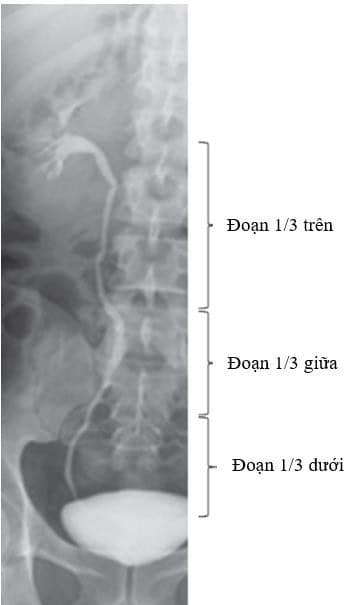 niệu quản thành 3 đoạn trên, giữa, dưới