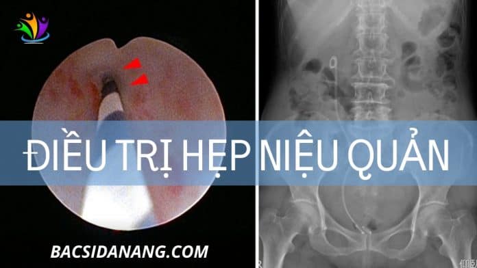 điều trị hẹp niệu quản