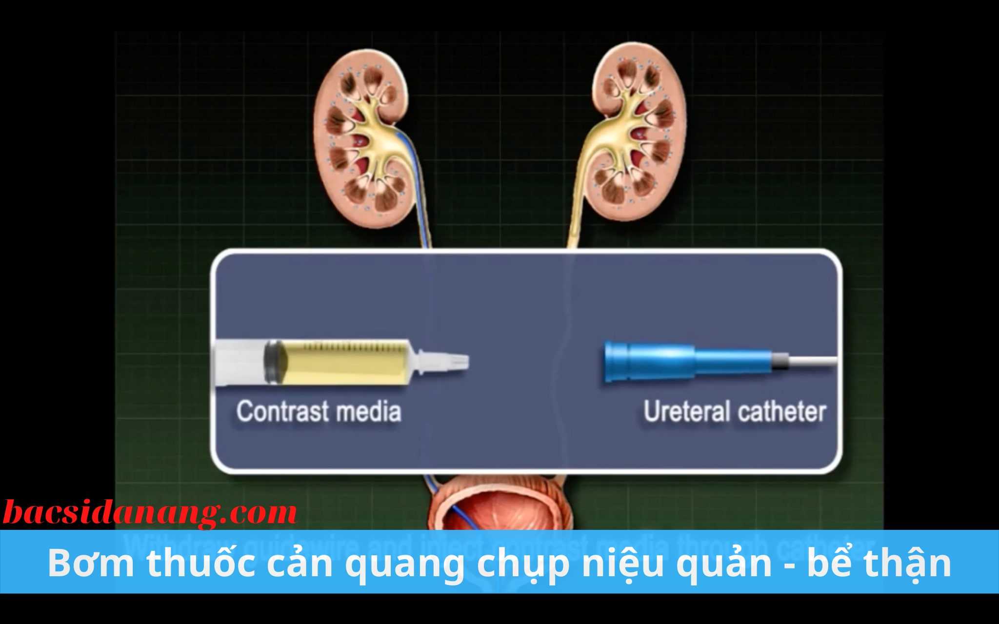 Đặt stent điều trị hẹp niệu quản, niệu đạo