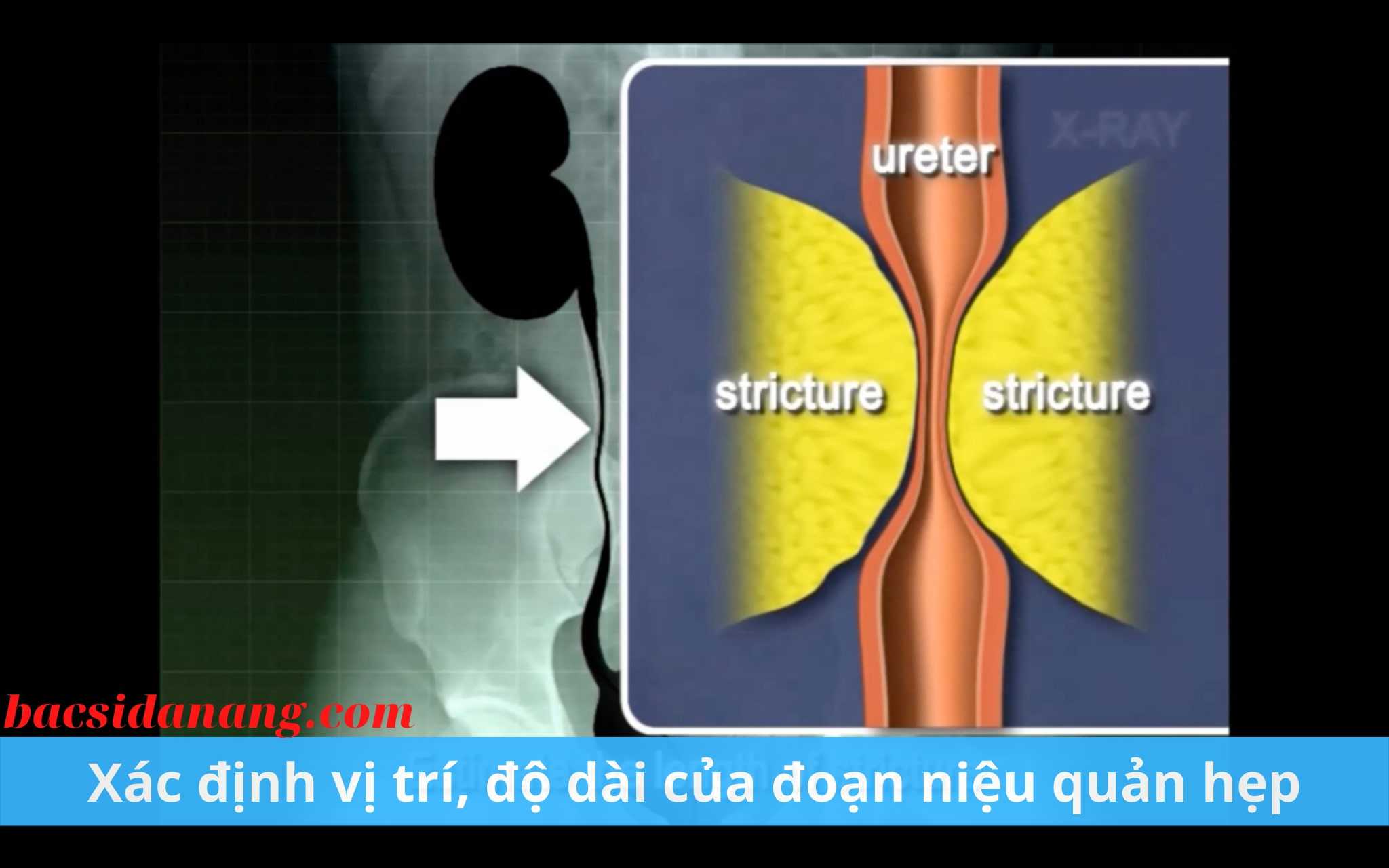 Đặt stent điều trị hẹp niệu quản, niệu đạo