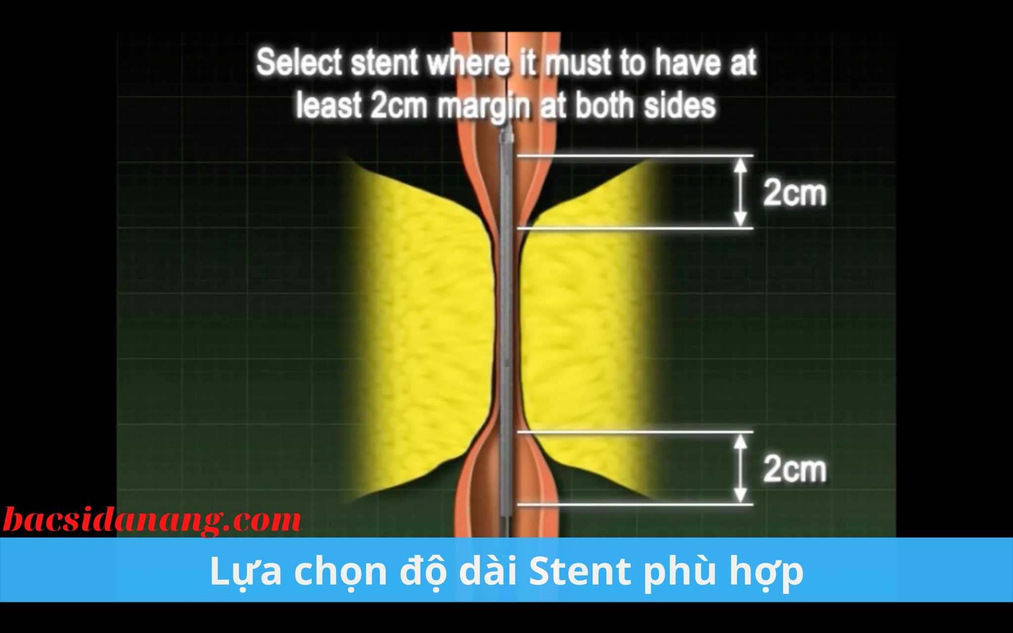 Đặt stent điều trị hẹp niệu quản, niệu đạo