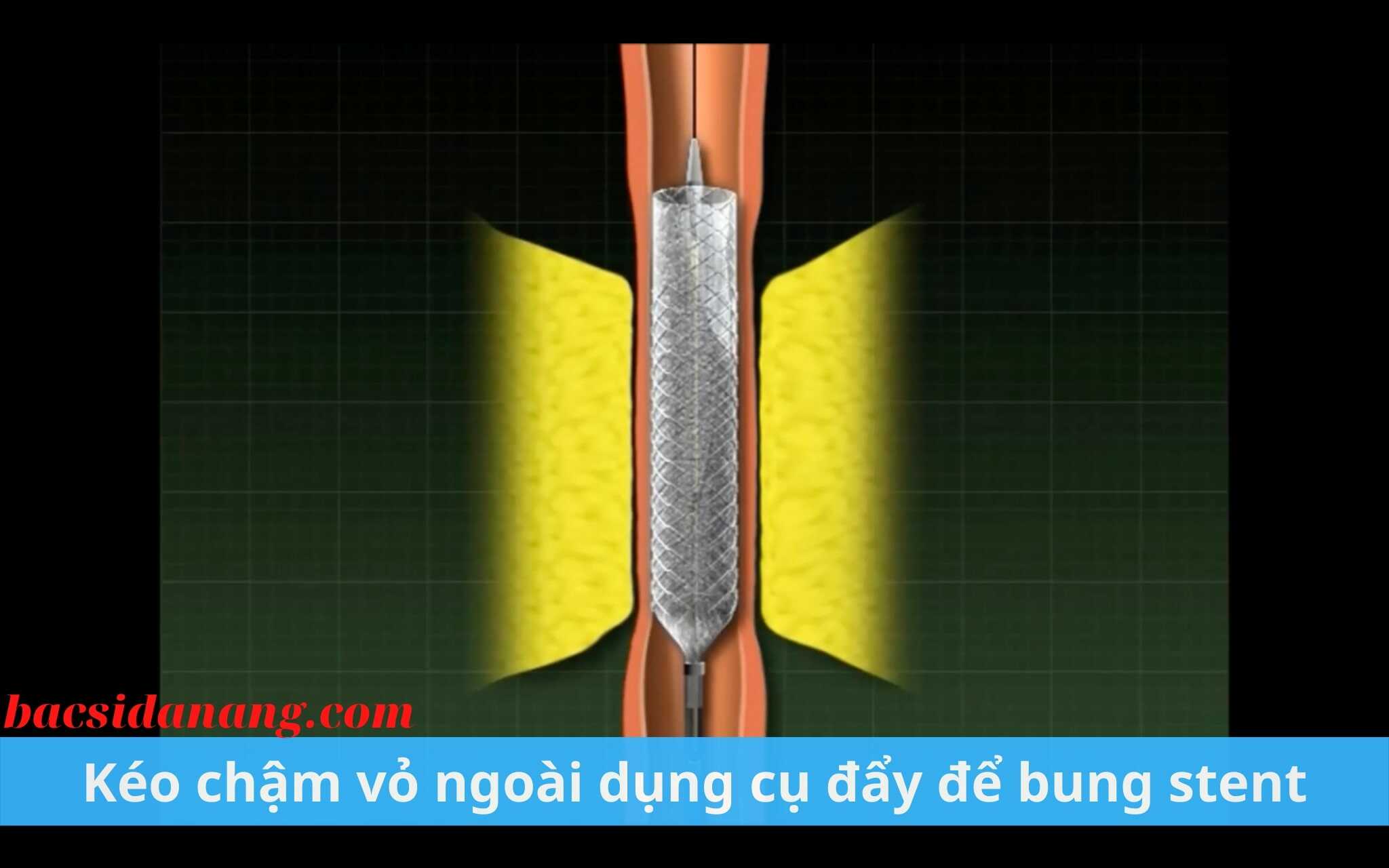 Đặt stent điều trị hẹp niệu quản, niệu đạo