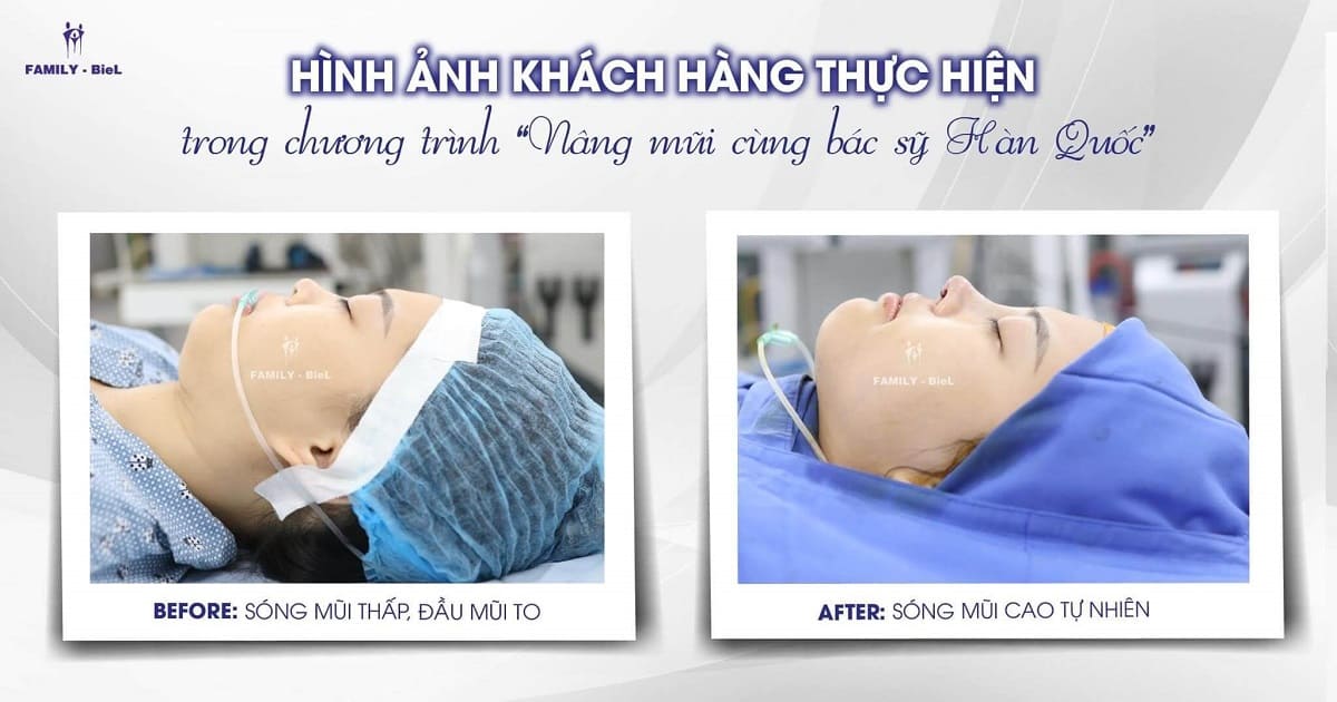 Kết quả trước – sau phẫu thuật nâng mũi cấu trúc sụn tai cùng bác sĩ Hàn Quốc tại Family BieL
