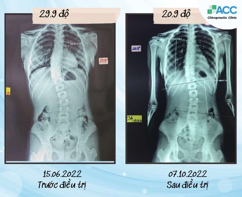 Hình ảnh kết quả điều trị vẹo cột sống sau 32 buổi điều trị của em T.N.N tại phòng khám ACC