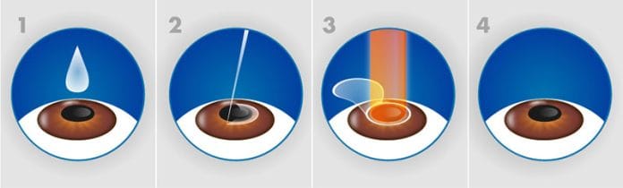 phau-thuat-lasik-3 phau-thuat-lasik-3