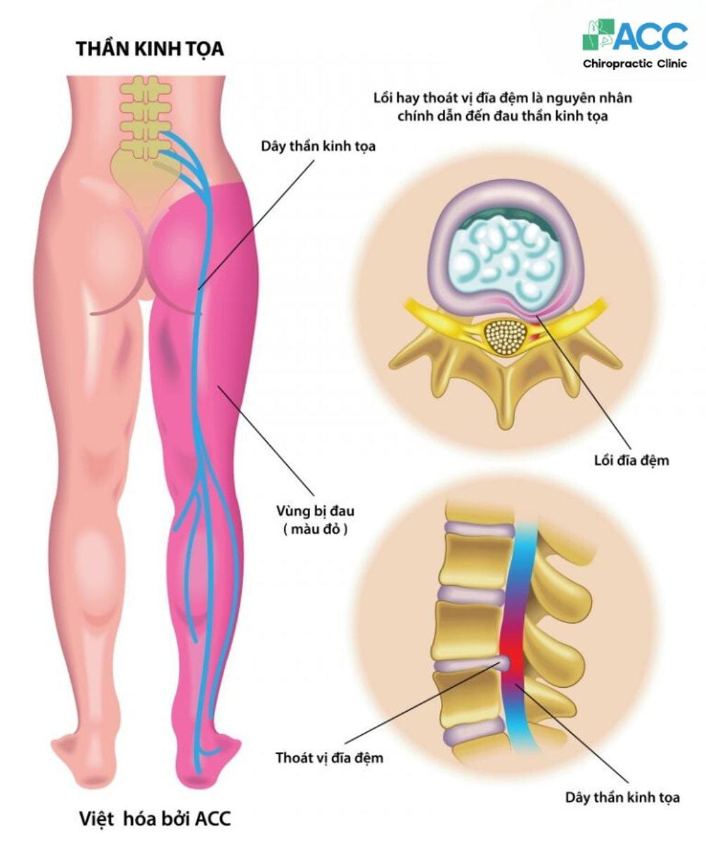 Điều trị đau thần kinh tọa bằng phương pháp Chiropractic 