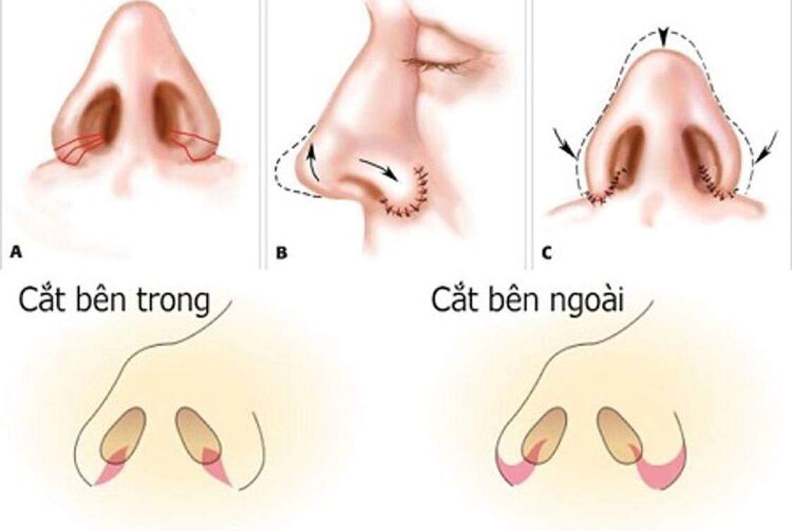 Phẫu thuật thẩm mỹ thu gọn cánh mũi ở Đà Nẵng