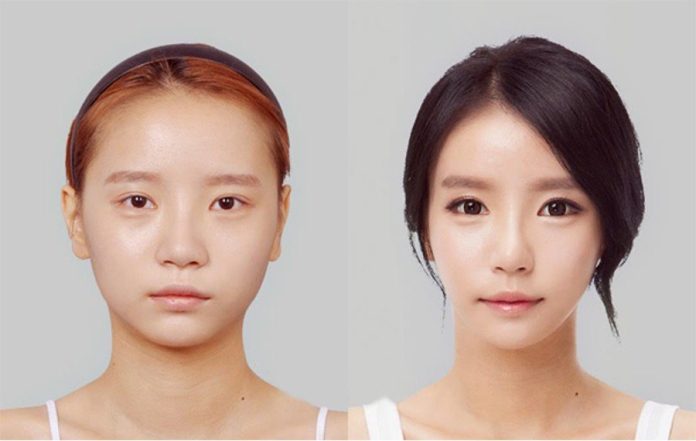 after-liposuction-of-the-cheek-area