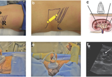 Ultrasound-Guided Mini-PCNL with Laser Lithotripsy: Minimally Invasive Kidney Stone Treatment in Da Nang