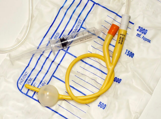 Đặt ống thông niệu đạo (Foley catheter): Đây là biện pháp can thiệp đầu tiên và phổ biến nhất. Một ống thông mềm sẽ được đưa qua niệu đạo vào bàng quang để dẫn lưu nước tiểu ra ngoài ngay lập tức.